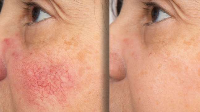 Rosyra Anti-Redness Serum