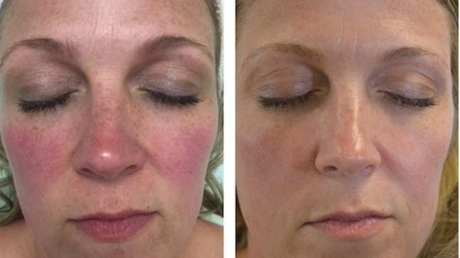 Rosyra Anti-Redness Serum